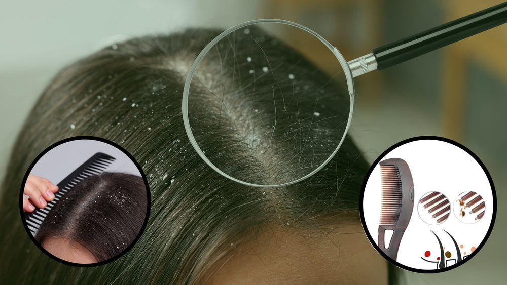 Is a Dandruff Comb Safe for Daily Use? Pros, Cons & Myths | Dolcy